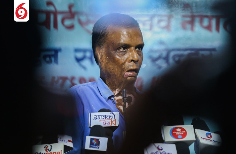 इट्टाभट्टामा जिउँदै जलाइएका घाइते काठमाडौँमा, भन्छन्,– श्रीमान म जिउँदै छु, म साक्षी होइन स्वयं प्रमाण हुँ