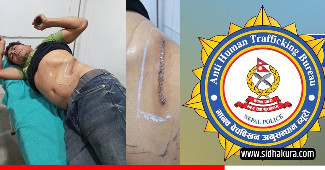 खिलबहादुरलाई भारत लगेर मिर्गौला तस्करी गर्ने एक जना पक्राउ, लिन्थे प्रति व्यक्ति ५० हजार कमिसन
